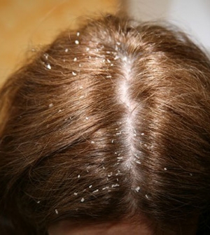 ekcémás fejbőr kezelése