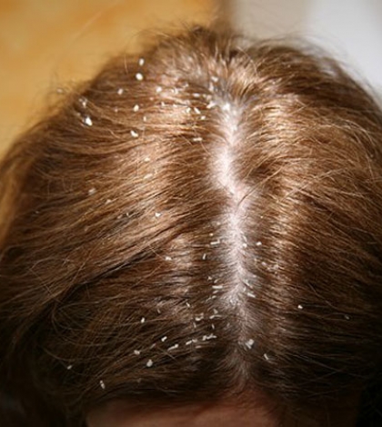 Vörös foltok és viszketés a fejbőrön - Allergiás reakció