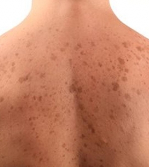 psoriasis traitement naturel homeopathie vörös folt a bőrön fotó leírással