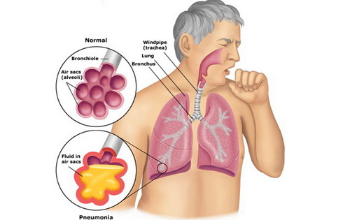 tuberkulózis helminth co fertőzés jel condylom