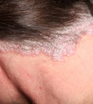 Pikkelysömörös fejbőr kezelése, ápolása - Fejbőrproblémák -