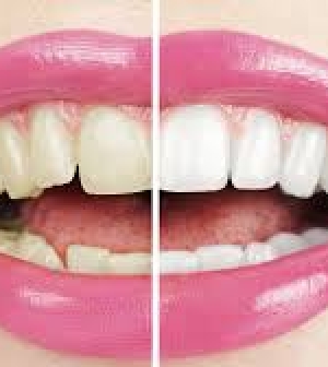 Mit is tegyél a ragyogóan fehér fogakért?