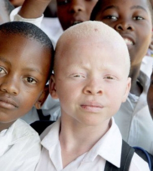 Brutális támadások az albínók ellen Afrikában