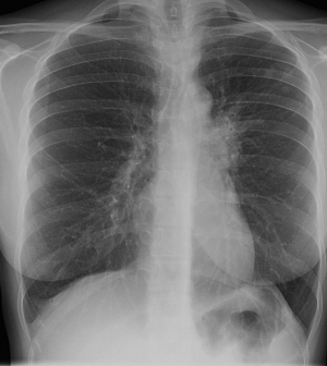 A tuberkulózis okoz-e fogyást - Hogyan terjed és mik a tbc tünetei?